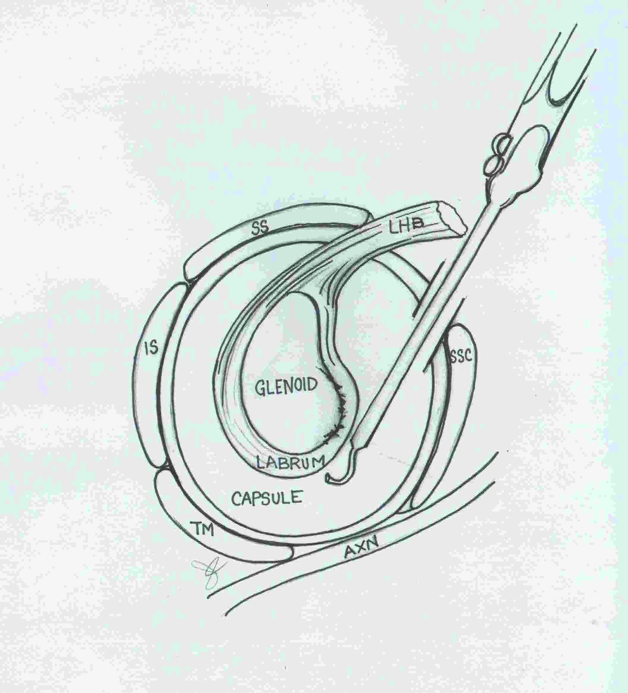 Labral Repair